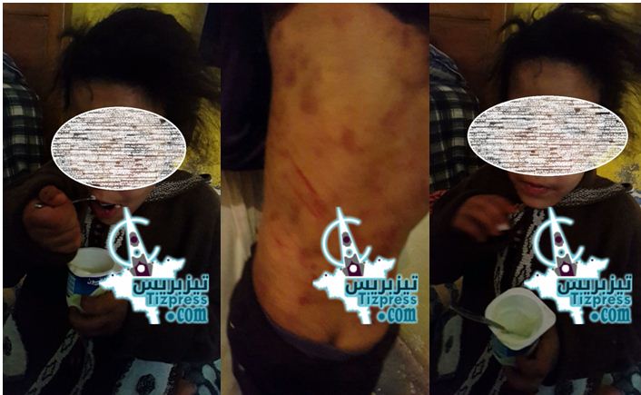سيدي إفني : بالصور و الفيديو ..تعذيب طفلة ذات الـــ 6 سنوات من طرف عمتها باﻻخصاص سيدي إفني : بالصور و الفيديو ..تعذيب طفلة ذات الـــ 6 سنوات من طرف عمتها باﻻخصاص