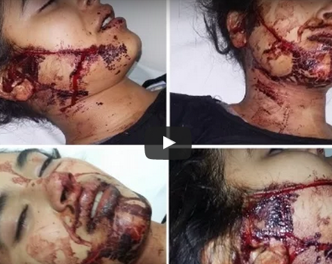 إنـــزكـــان : بالفيديو .. “20 غرزة جراحية” لإيقاف نزيف دماء بعد أن قطع جزار لسان فتاة و شرمل و جهها بسكين إنـــزكـــان : بالفيديو .. “20 غرزة جراحية” لإيقاف نزيف دماء بعد أن قطع جزار لسان فتاة و شرمل و جهها بسكين